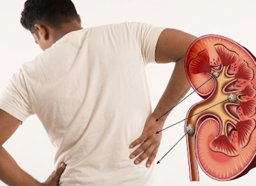 How Summer Heat in India Increases the Risk of Kidney Stones (And What You Can Do)