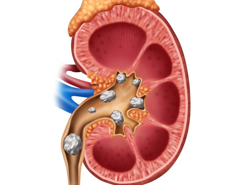 Kidney stones medical concept as a human organ with painful crystaline mineral formations as a medical symbol with a cross section as a 3D illustration style.